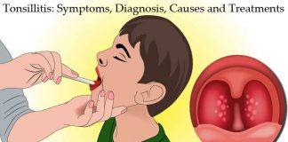 Tonsillitis: Symptoms, Diagnosis, Causes and Treatments