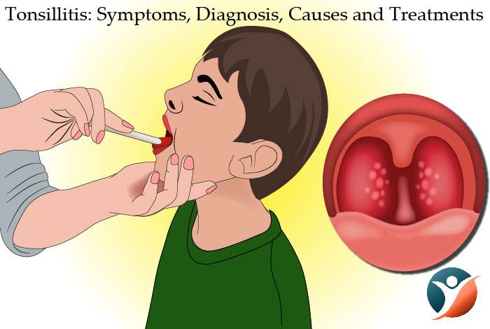 Tonsillitis: Symptoms, Diagnosis, Causes and Treatments