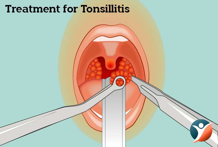 Treatment for Tonsillitis