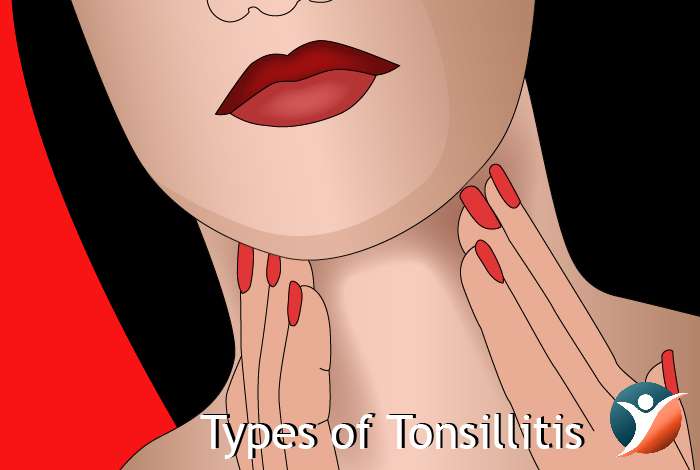 Types of Tonsillitis 