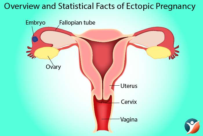 Overview and Statistical Facts of Ectopic Pregnancy