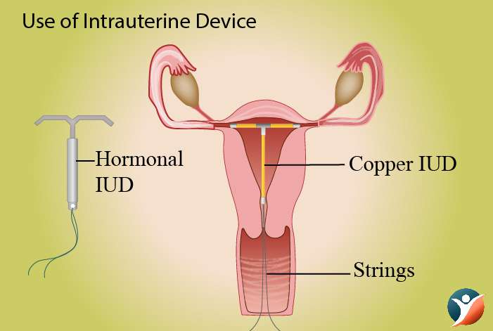 Use of Intrauterine Device
