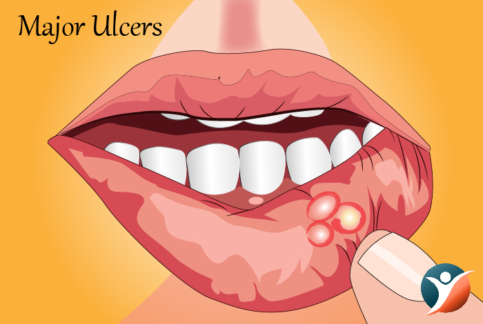 Major Ulcers