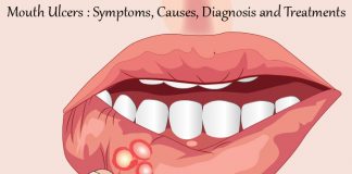 Mouth Ulcers : Symptoms, Causes, Diagnosis and Treatments