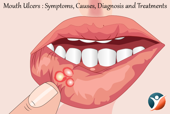 Mouth Ulcers : Symptoms, Causes, Diagnosis and Treatments