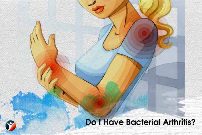 Do I Have Bacterial Arthritis