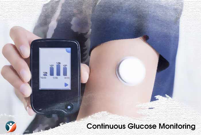 Everything You Need to Know about Continuous Glucose Monitoring System