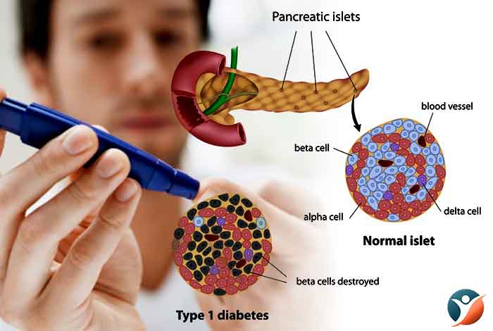What is Type I Diabetes?
