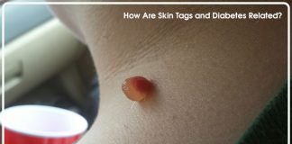 Is There an Association Between Skin Tags and Diabetes?