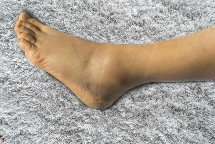 Swelling-feet